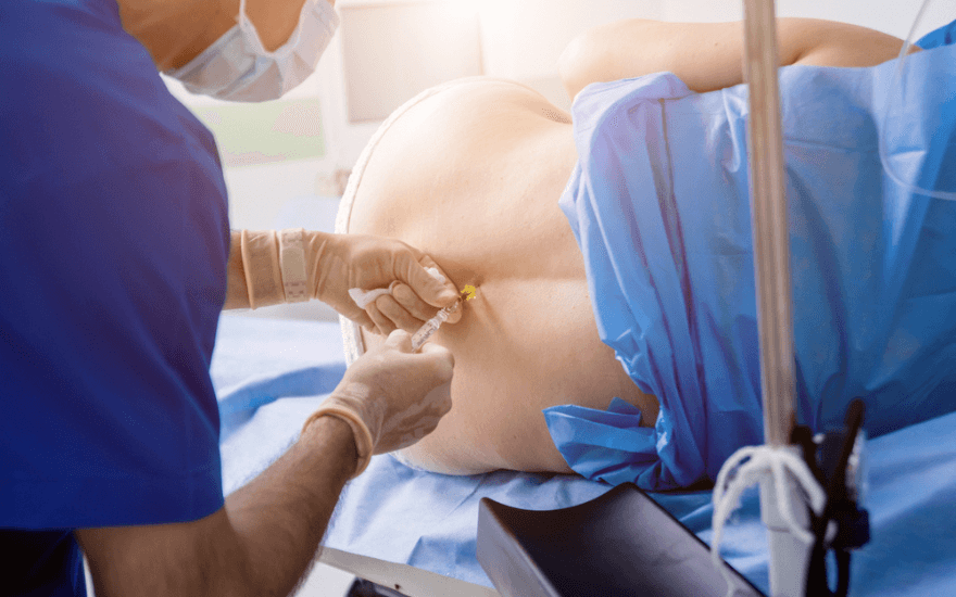 Everything You Need to Know About Epidural