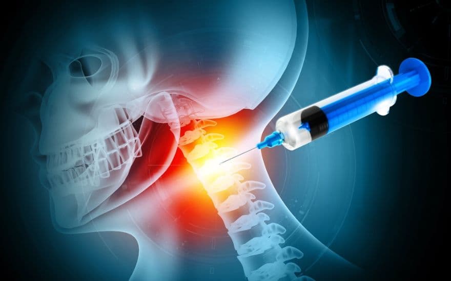 CESI: Procedure and Effectiveness for Pain Management
