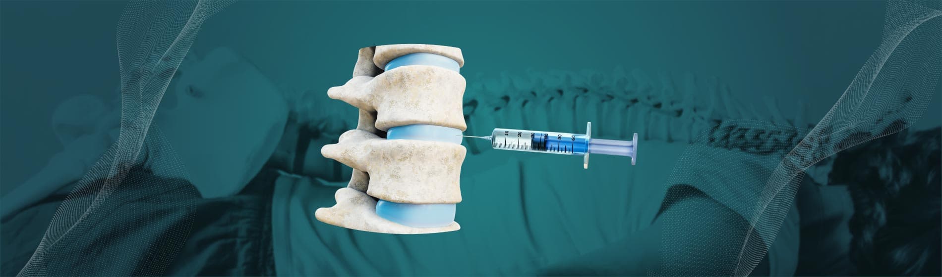 Understanding Spinal Injections for Nerve and Disc Pain