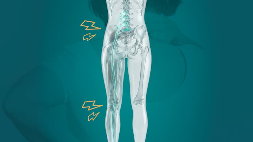 Diagram of referred pain radiating from spine and hip to the leg