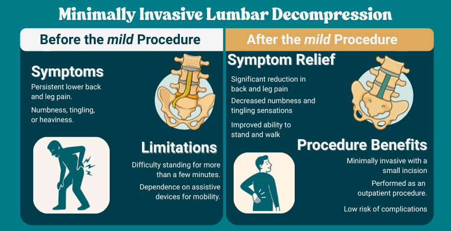 Minimally Invasive Lumbar Decompression