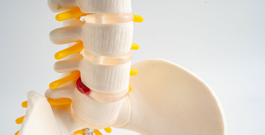 Understanding Spinal Injections for Nerve and Disc Pain