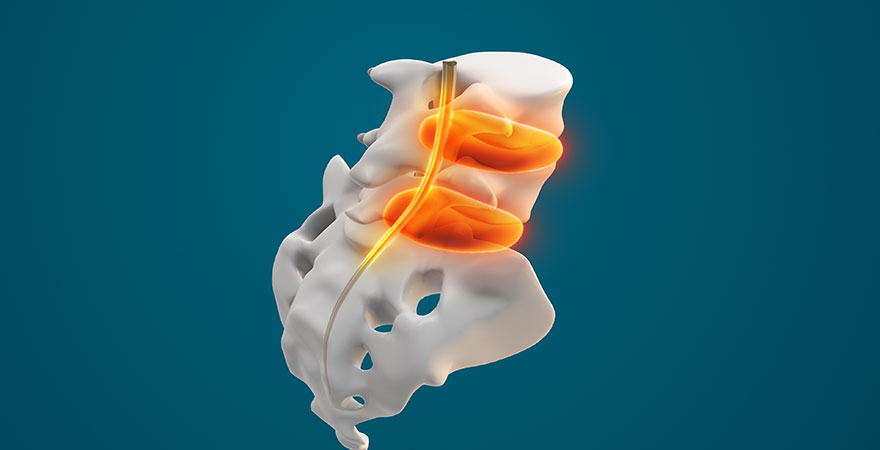 Understanding Spinal Injections for Nerve and Disc Pain