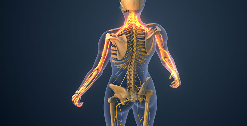 Illustration of radiating nerve pain from the neck into the arms